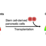 Stem Cell Therapy for Diabetes in India: A Revolutionary Approach