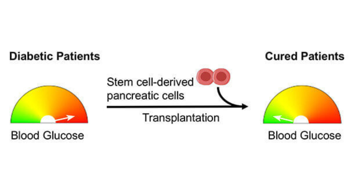 Stem Cell Therapy for Diabetes in India: A Revolutionary Approach